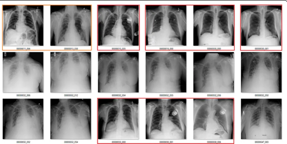 Fig. 1 Images from the ChestXray14 dataset labelled as showing atelectasis (red boxes indicate wrong label, orange indicate doubtful)