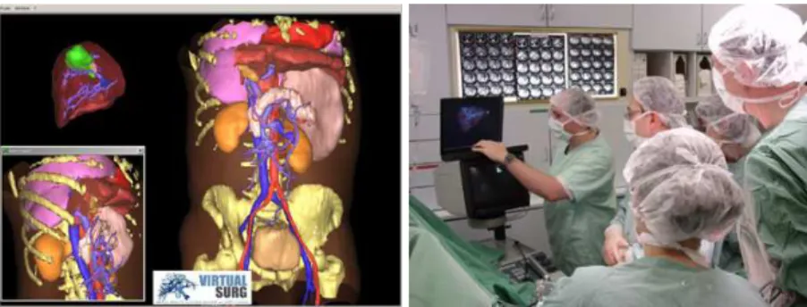 Figure 1 : Virtual resection of a 3D reconstructed liver of a patient from his/her medical images and  intra-operative clinical use of the planning software on a laptop