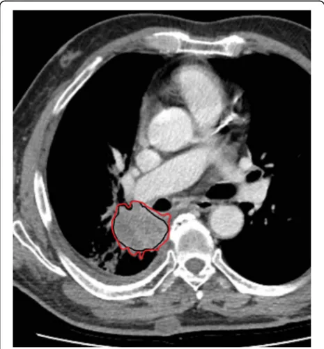 Fig. 3 Axial T2-weighted images of the pelvis, acquired keeping unchanged all the parameters, with only exception of the echo time, which wasclearly depicted by the signal of the bladder (white star), with higher and higher signal intensity from34 ms in (a), 90 ms in (b), and 134 ms in (c), showing that even one single parameter can change the signal intensity of tissues and fluids, as a to b to c