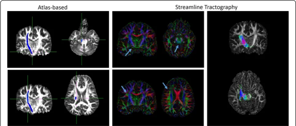 Fig. 2 Example of regions of interest used for the atlas-based (FMRIB software library [FSL] software) and streamline tractography (ExploreDTIsoftware) approach