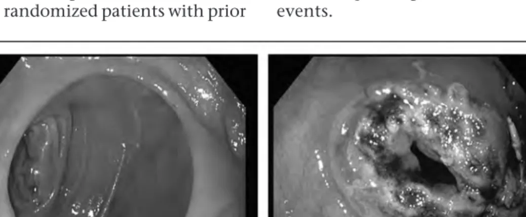 FIGURE 2. Gastrojejunal stoma revision using endoscopic suturing techniques to reduce an enlarged stoma from 35 to 8 mm.
