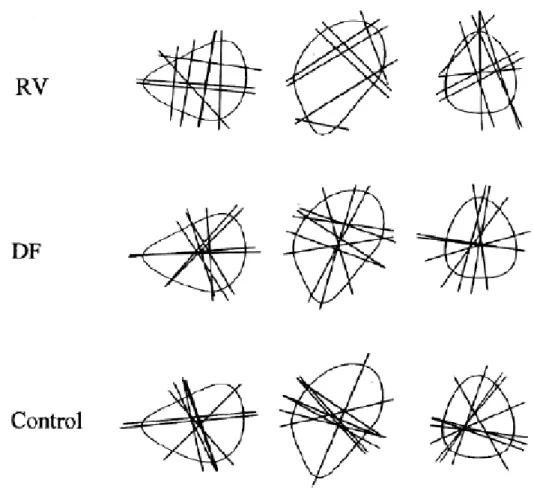 Figure  3  The 'grasp lines' (joining points where the index finger and the thumb first made contact with the  shape) selected by a patient with optic ataxia (R.V.), a patient with visual form agnosia (D.F.), and  the control subject when picking up three 