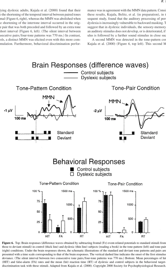 Figure 6. Top: Brain responses ~difference waves obtained by subtracting frontal ~Fz! event-related potentials to standard stimuli from those to deviant stimuli! in control ~thick line! and dyslexic ~thin line! subjects ~reading a book! in the tone-pattern