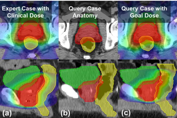 Figure 6 shows DVHs for example cases. For case #07 (Figure 6(a)), the DAP plan  has better bladder sparing. For case #08 (Figure 6(b)), the DAP plan has similar plan  quality with the clinical plan. The DAP plan of case #11 (Figure 6(c)) shows worse  rect