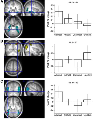 Fig. 4. Voxel-wise results. On the left, statistical parametric maps of regions implicated in object recognition shown on orthogonal sections through a normalised structural of oneparticipant