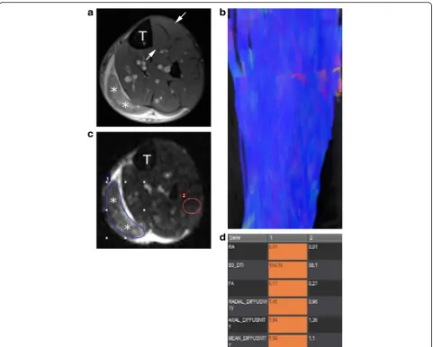Fig. 1 a Axial fat-saturated proton-density image of the middle third of the leg of a 29-year-old male patient who sustained a grade 2c tear ofthe medial gastrocnemius muscle (asterisks)