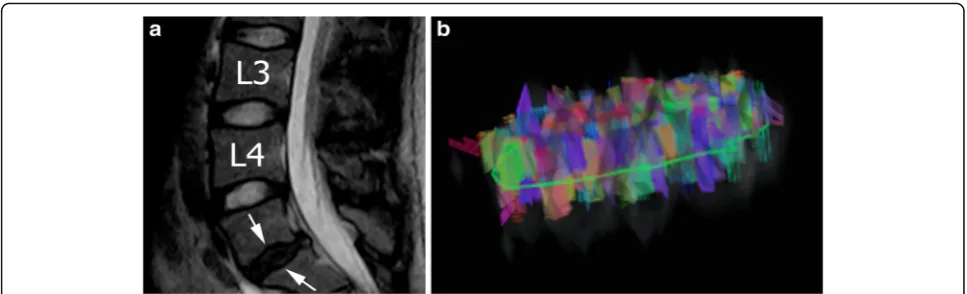 Fig. 4 Magnetic resonance of the lumbar spine performed on a of 31-year-old man. a Sagittal T2-weighted image shows protrusion of a thinnedand dehydrated intervertebral disc (Pfirrmann IV, arrows) at L5-S1