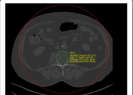 Fig. 1 After automatic placement by the post-processing software(Examine, Siemens), the VOI was manually defined by the user in orderto achieve the best delineation of the trabecular bone and exclusionof any cortical bone