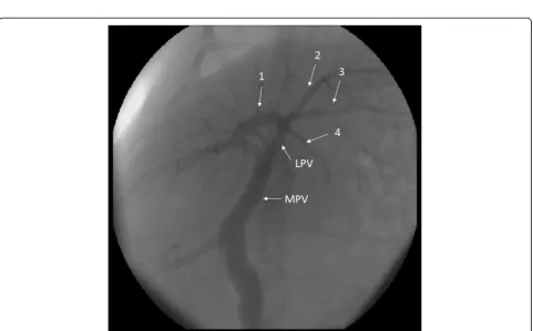 Fig. 2 Anatomic variation type 2: trifurcation of the left portal vein (LPV). The LPV bifurcates into three segmental branches (arrows 1, 2 and 3).MPV main portal vein