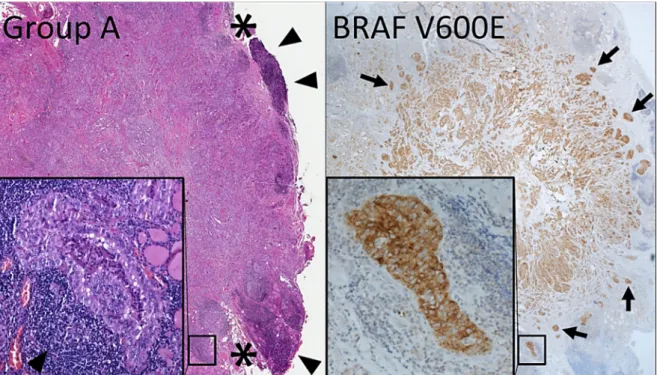 Figure 6. Histologic appearance (hematoxylin and eosin section, H&amp;E) of group A microcarcinomas (left image  and inset)