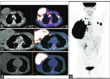 Figure 3: Three dimensional maximum intensity projection (a),  axial CT and axial fused images for a 77-year-old female patient  presented with left breast neoplasm; by conventional staging,  the patient was stage T1N1M0 (stage IIA)