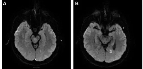 Figure 1 Typical manifestation of migrainous infarct on MRI diffusion weighted imaging in a 45-year-old female patient with chronic migraine with aura.