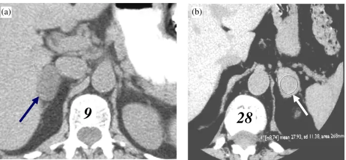 Figure 1 (a) Unenhanced images show a right adrenal mass (arrow) with a density measurement of 9 HU.