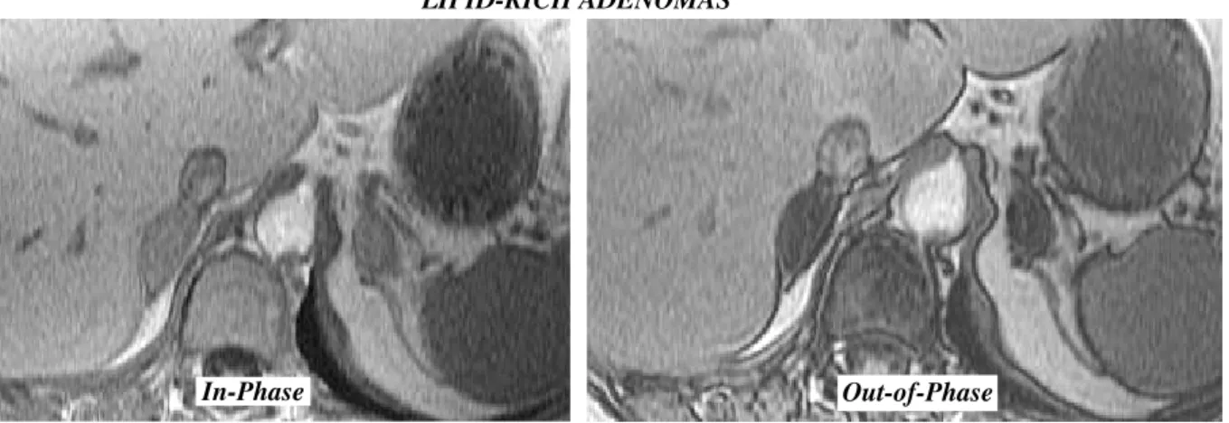 Figure 5 On the out-of-phase images, bilateral adrenal masses show pronounced loss of SI when compared to the in-phase images using the spleen as a reference, proving that the masses contain lipid and are lipid-rich adenomas.