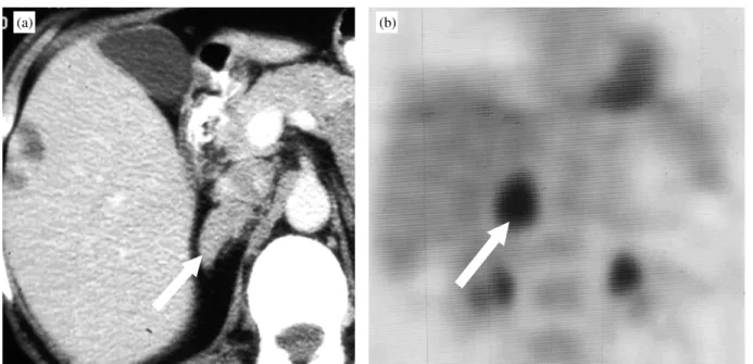 Figure 9 In a patient with colon cancer and rising CEA (carcino-embryonic antigen). (a) CT shows right adrenal mass (arrow), (b) which takes up FDG on PET scan