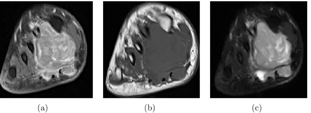 Figure 2.1. Three MRI sequences. (a) T1 post-contrast (b) T1 pre-contrast (c) T2 non- non-contrast of Soft tissue Sarcomas from private dataset