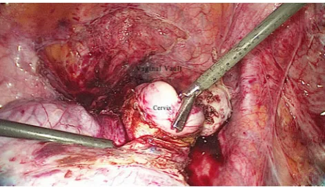 Fig. 5 Final separation of the rectum from the uterus