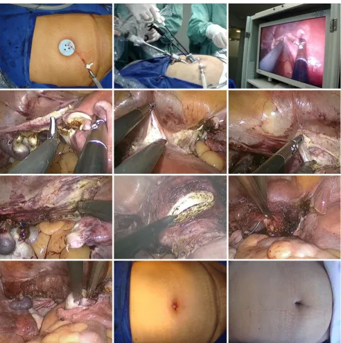 Fig. 2 Single-port total laparoscopic hysterectomy using the SILS device