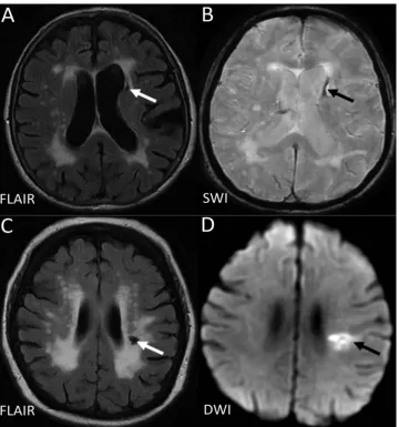 Figure 3Example of MRIs of a lacune from a haemorrhagic source (A,B), and from a lacunar infarct (C, D)