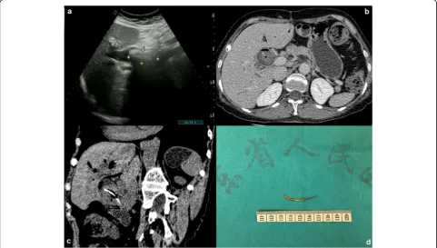Fig. 1 Exploration and truth of the long high-density shadow. a Abdominal ultrasonography view of the biliary tract shows choledocholithiasis(4.4 cm × 2.0 cm) with dilatation of intrahepatic and extrahepatic bile duct