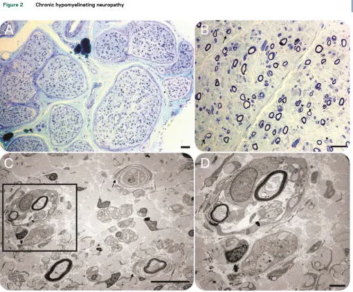 Figure 2Chronic hypomyelinating neuropathy