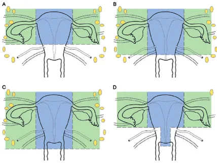 Fig. 1 Variations of laparoscopic hysterectomies (bluefurther surgery.the round ligament, adnexa and infundibulopelvic ligament from thepelvic side wall above the cardinal ligament with or withoutlymphadenectomy; the uterus is extracted via the vagina