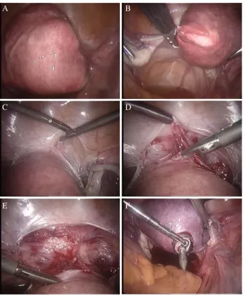 Fig. 3 Classic intrafascial sub-total hysterectomy (CISH).Multifibroid uterus,of left adnexa from the uteruswith a stapler,vesico-uterine space,tion of the bladder,stration of the pericervicalfascial ring, a b dissection c opening of the d prepara- e demon- f transcervical andtransuterine resection of a 15-mm tissue cylinder including the“transformation zone around anaxial guide rod”, g positioningof a “Roeder loop” as tourniquetto tie the ascending branches ofthe uterine arteries, h sharp dis-section of cervix from the uter-ine corpus with scissors (or amonopolar loop as LINA Loopor Storz cervical loop), i furthercervical dissection, j separationof uterine body from the cervix,k morcellation of the uterus andl irrigation leaving the visceralperitoneum open