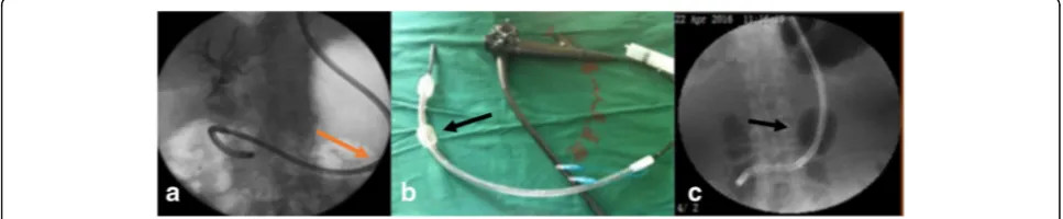Fig. 1 Guide wire guide method.wire through the endoscopic working channel; a ultraslim endoscope through the opening of the duodenal papilla to the distal end of the bile duct; b insertion guide c fluoroscopy confirmed that the guide wire reached the intrahepatic bile duct; d ultraslim endoscopeinsertion to the common hepatic duct along the guide wire, arrow pointed to the opening of the cystic duct