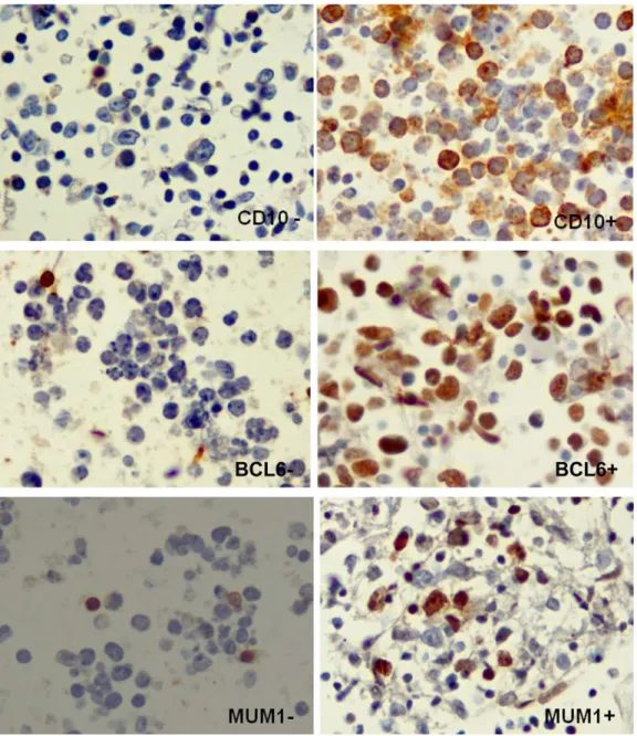 Figure 2. Immunostaining with CD10, B-cell lymphoma 6 (BCL6), and multiple myeloma oncogene 1 (MUM1) in diffuse large B-cell lymphoma cell blocks