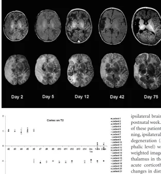Fig 3. Images show the temporal evolution of a right-sidedmain branch MCA territory infarction (patient 1) on T1-weighted images (top row) and T2-weighted images (bottomrow) obtained on days 2, 5, 12, 42, and 75 postdelivery.