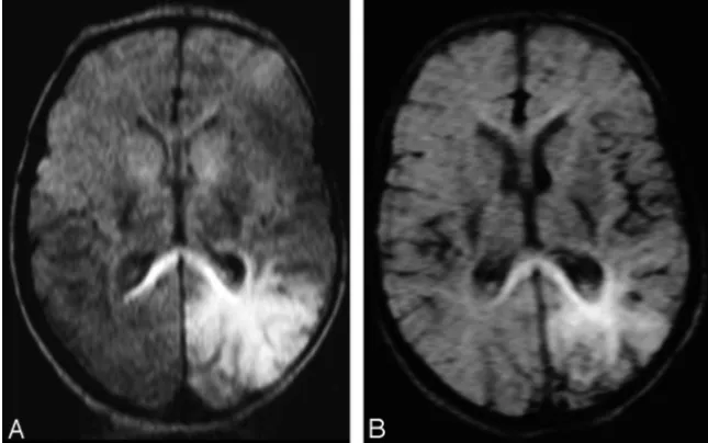 Fig 9. Graph shows DWIs of a patient with an infarction