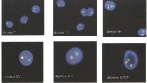 Figure 2 : Hybridation in situ de sondes chromosomiques fluorescentes sur le spermatozo~de humain (sondes pour les chromosomes 7, 16, 18, X et Y)