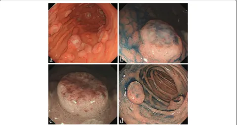 Fig. 1 Endoscopic images of the stomach and duodenum affected by MTX-LPD. a, Before the withdrawal of MTX treatment, there were multipledish-like lesions in the stomach