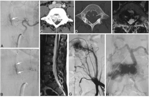 Fig 1. Ventral epidural AV fistulas in 2 different patients.late (with no reflux toward the cord