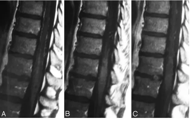 Fig 3. When comparing a routine T2 TSE (A) sequence and a heavily T2-weighted (FIESTA,3D T2 TSE, or CISS) sequence (B), the former depicts the cord edema better (arrow, A),whereas the latter is better suited to demonstrate the perimedullary flow voids (arrow, B),as seen in this patient.