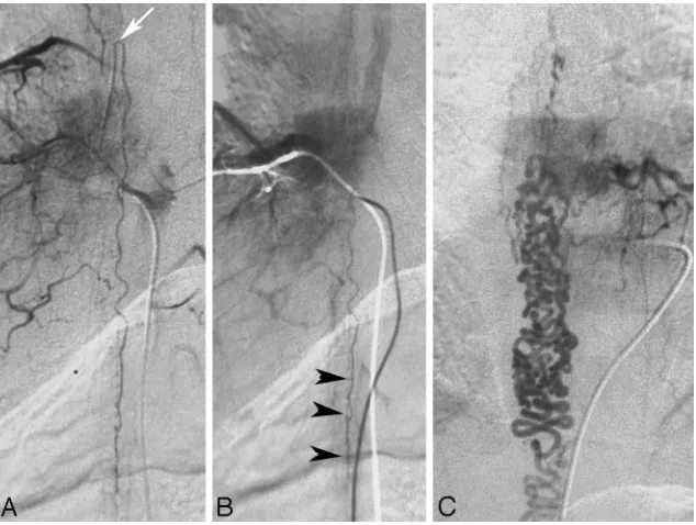 Fig 5. First-pass contrast-enhanced MRA can clearly demonstrate the early venous filling and thereby confirm the presence of a shunt in equivocal cases.( A and B, On T2-weighted scansA), the perimedullary flow voids indicate an SDAVF, which is confirmed on