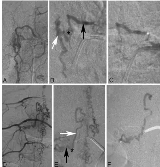 Fig 7. Endovascular therapy in DAVFs in 2 different patients (from the pedicle from which the spinal DAVF is fed