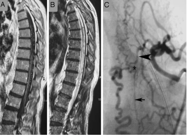 Fig 8. Images of this patient with the classic MR imaging findings of a DAVF on T1-weighted contrast-enhanced (additional supply ascending from a lower segmental artery (arteries in the shunting zone