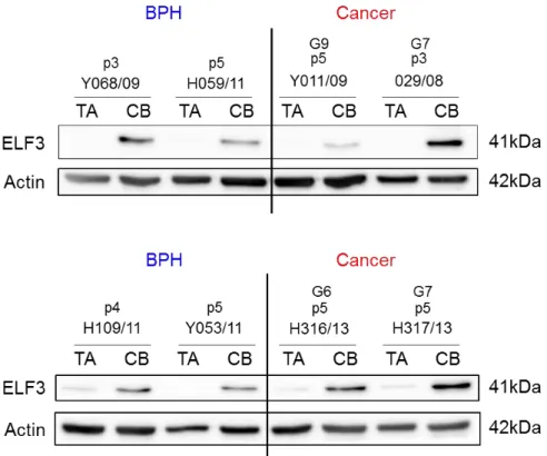 Figure 3.3. Protein expression of ELF3 in the fractionated cell subpopulations from primary prostate  benign and tumour samples
