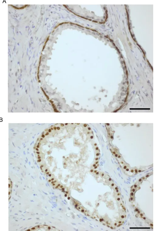 Figure 3.10. ELF3 expression  in BPH tissue using the  ImmPRESS Excel Amplified  HRP Polymer  Staining Kit