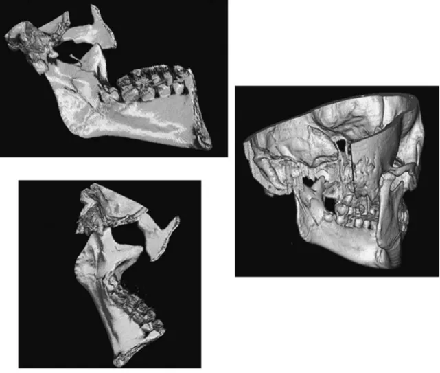 Figure 1 Three-dimensional manipulation demonstrating lingual view of a nondisplaced left mandibular angle fracture extending through an impacted third molar.