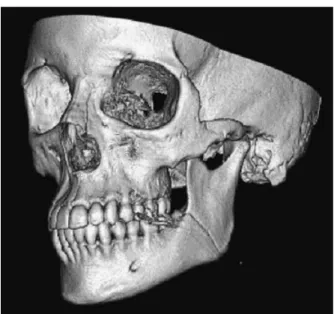 Figure 4 Comminuted right zygomatic arch fracture demonstrated in standard two-dimensional coronal image and an obliquely angled three-dimensional reconstruction better  dem-onstrating displacement of the fracture fragments.