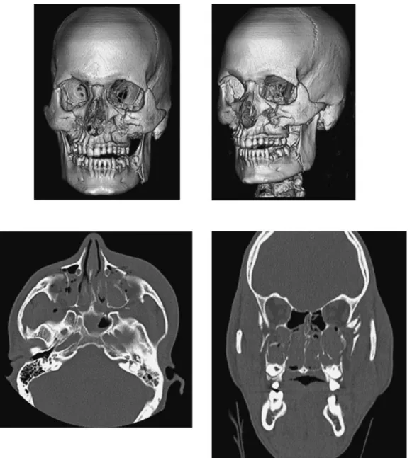 Figure 6 Axial and coronal two-dimensional images demonstrate extensive comminuted fractures involving the medial and lateral walls of the maxillary sinuses as well as the bilateral zygomatic arches