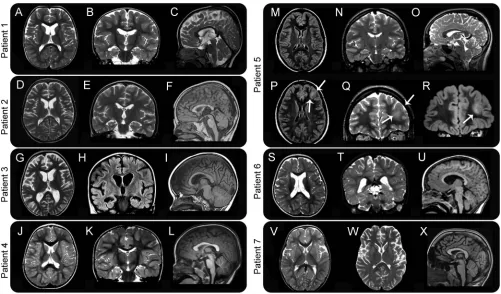 Figure 2MRI characteristics of 7 patients with GNAO1 mutations