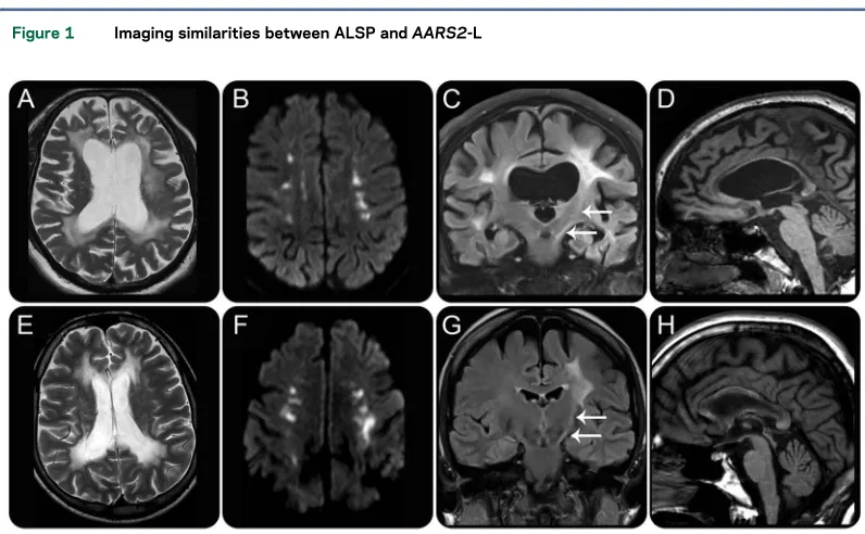 Figure 1Imaging similarities between ALSP and AARS2-L