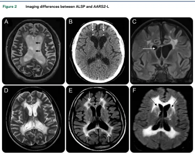 Figure 2Imaging differences between ALSP and AARS2-L