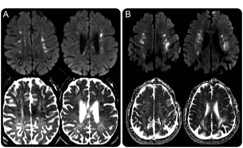 Figure 3“Deep white matter diffusion dots” in ALSP and AARS2-L