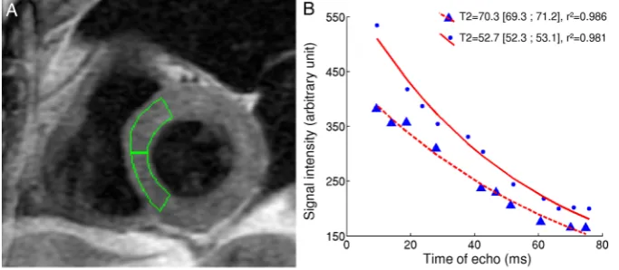 Figure 2Illustration of our method to quantify myocardial Tcorresponding to the signal intensity within a given septal region of interest for each image acquired with 10 different echo times.Myocardium with higher T2