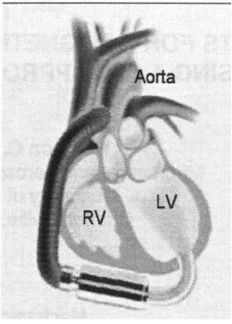 Figure 1.  Layout of Similar Axial LVAD [2] 
