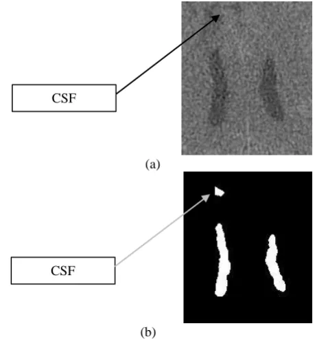 Fig. 9. (a) A region of interest; (b) Segmented CSF regions. Choroid plexus is a factor which can cause the error